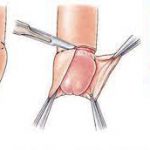 Phẫu thuật cắt bao quy đầu thực hiện thế nào?
