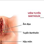Viêm tuyến Bartholin và phương pháp điều trị