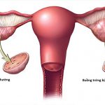 Phụ nữ có hội chứng buồng trứng đa nang cần lưu ý gì?