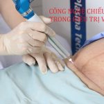 Công Nghệ Chiếu Tia Plasma Trong Điều Trị Vết Thương!