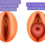 Đặt Vòng Nâng Cổ Tử Cung Trong Bệnh Lý Sa Tạng Chậu.